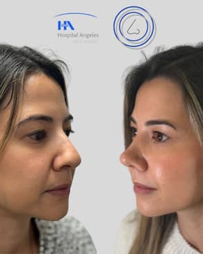 Slider image (3) Dr. Guillermo Guerra Gil de Leyva - Rhinoplasty Specialist